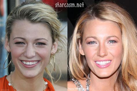 blake lively before and after plastic surgery